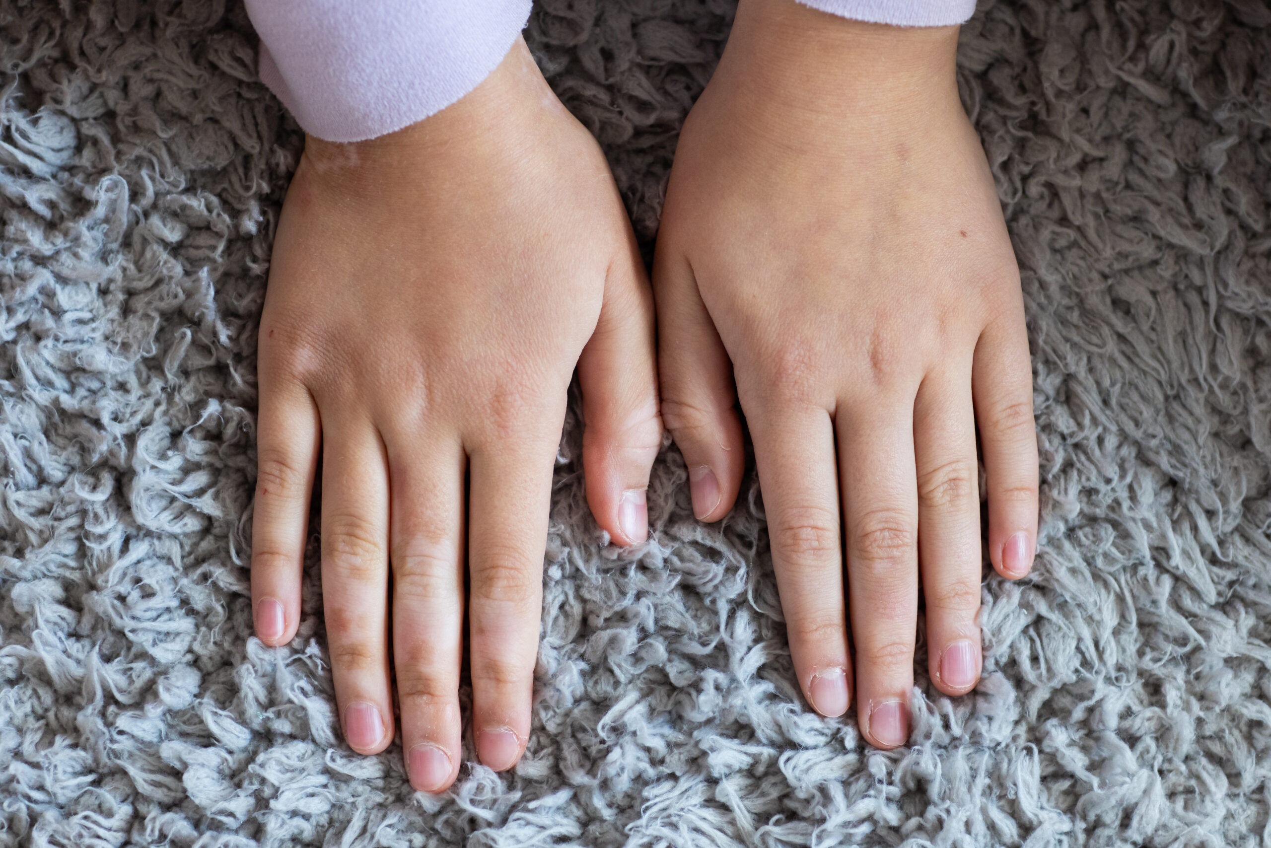 Child hands with vitiligo resting on gray carpet. Top view.